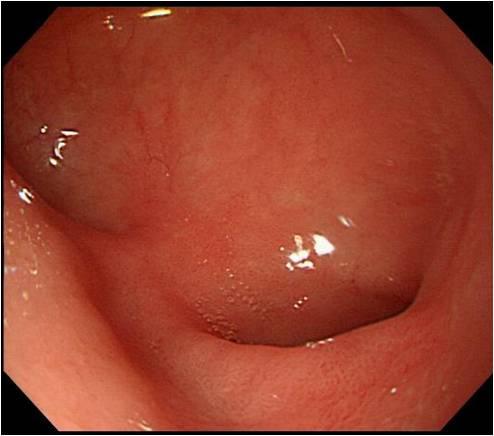 duodenum, hospital day 27. Figure 4.