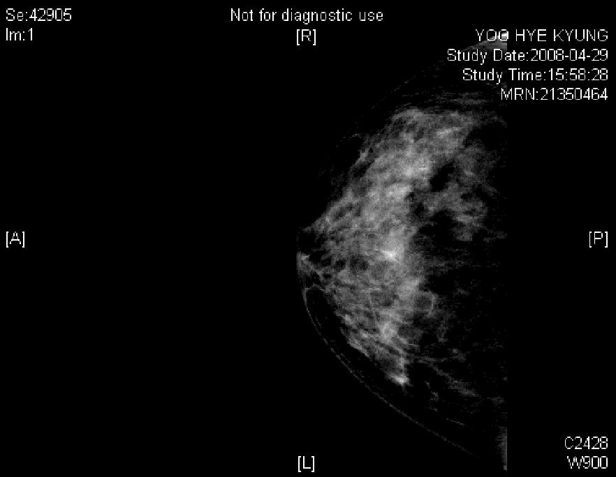 난소암 Mammography: 유방촬영유방에서발생하는질병과난소암의관련성확인을위해시행하는검사입니다. 유방내의종괴유무, 크기와모양, 피부두께, 유선의확장, 섬유화등을정밀하게진단할수있도록특별히고안된 X-선촬영기로촬영하는검사로서, 촬영방법은가능한많은부분이사진에포함되도록적절한촬영자세를취한후유방을납작하게압박을하여촬영하게됩니다.