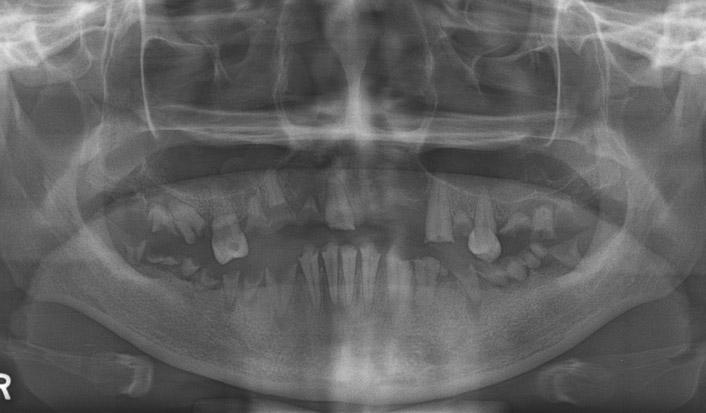 Supraeuption of #15 and dentoalveolar protrusion of mandibular anterior teeth could be identified and the necessity of