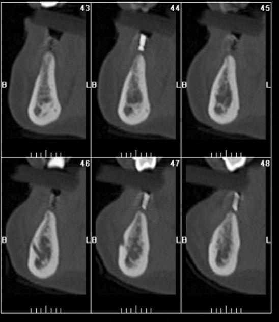 Fig. 6. CT image of mandible.
