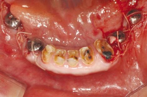 #42. Fig. 9. Healing after gingivectomy and CLP.