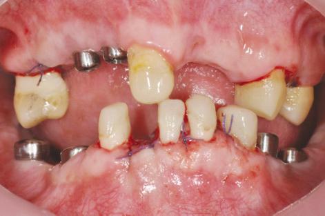 of mandibular anterior teeth were attained. Fig. 10.