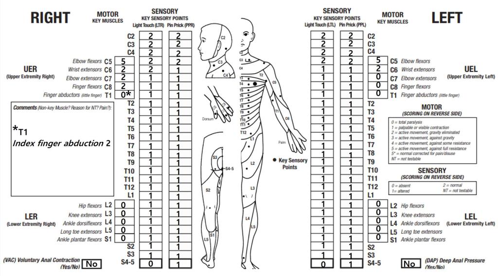 2018 년대한재활의학회전공의평가시험 - 6-12. International Standards for Neurological Classification of Spinal Cord Injury 검사결과가아 래와같을때, neurologic level of injury (NLI) 와 ASIA impairment scale (AIS) 이옳게짝지어진 것은?
