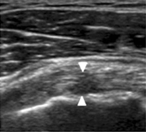 The partial-thickness tear in supraspinatus tendon was noted on