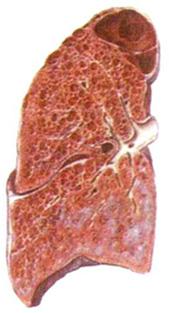 (Asbestosis), 폐암 (Lung cancer),