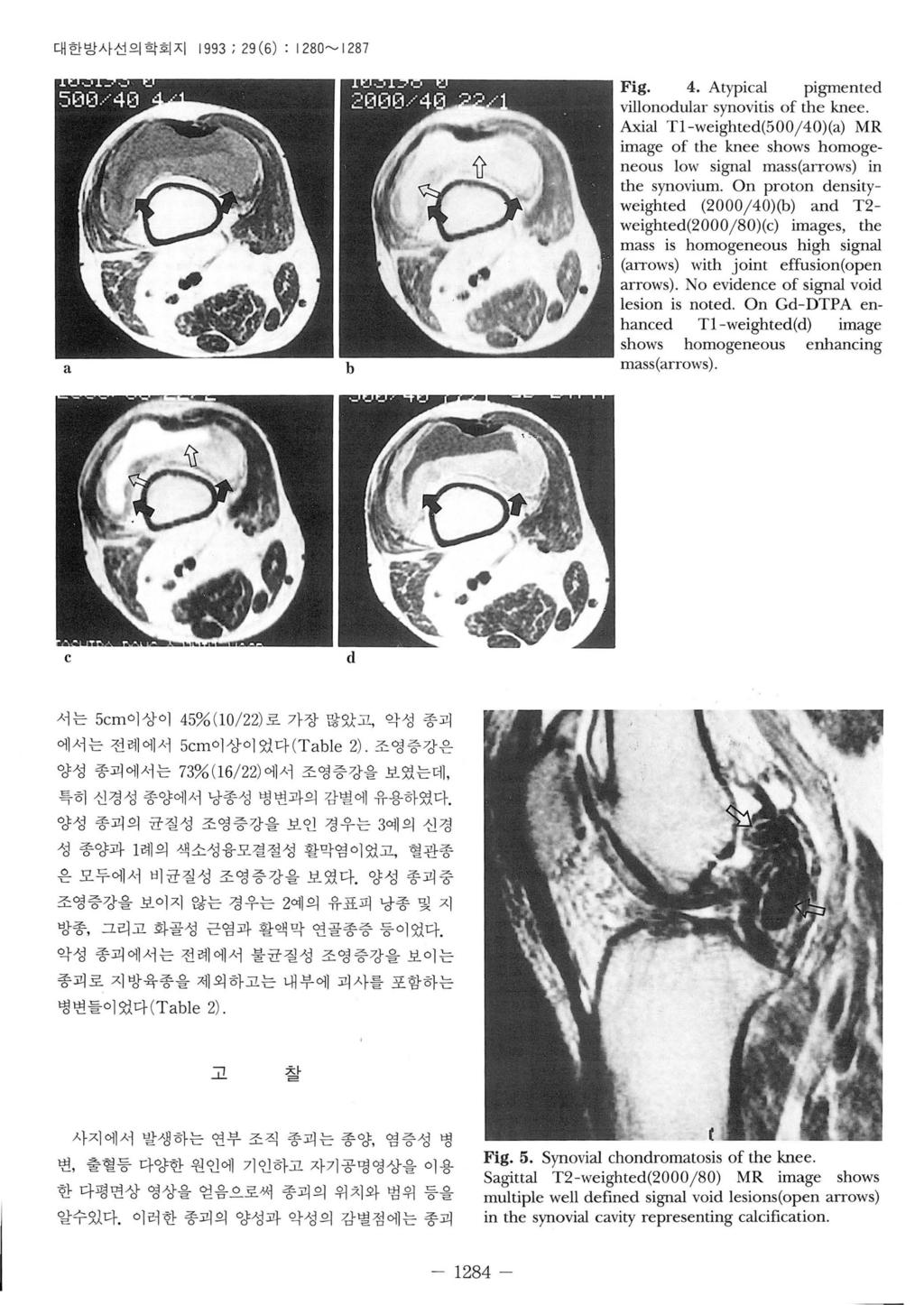 대한방사선의학회지 t 993 ; 29 (6) : t 280~ t 287 a Fig. 4. Atypic외 pigmented villonodular synovitis of the knee.