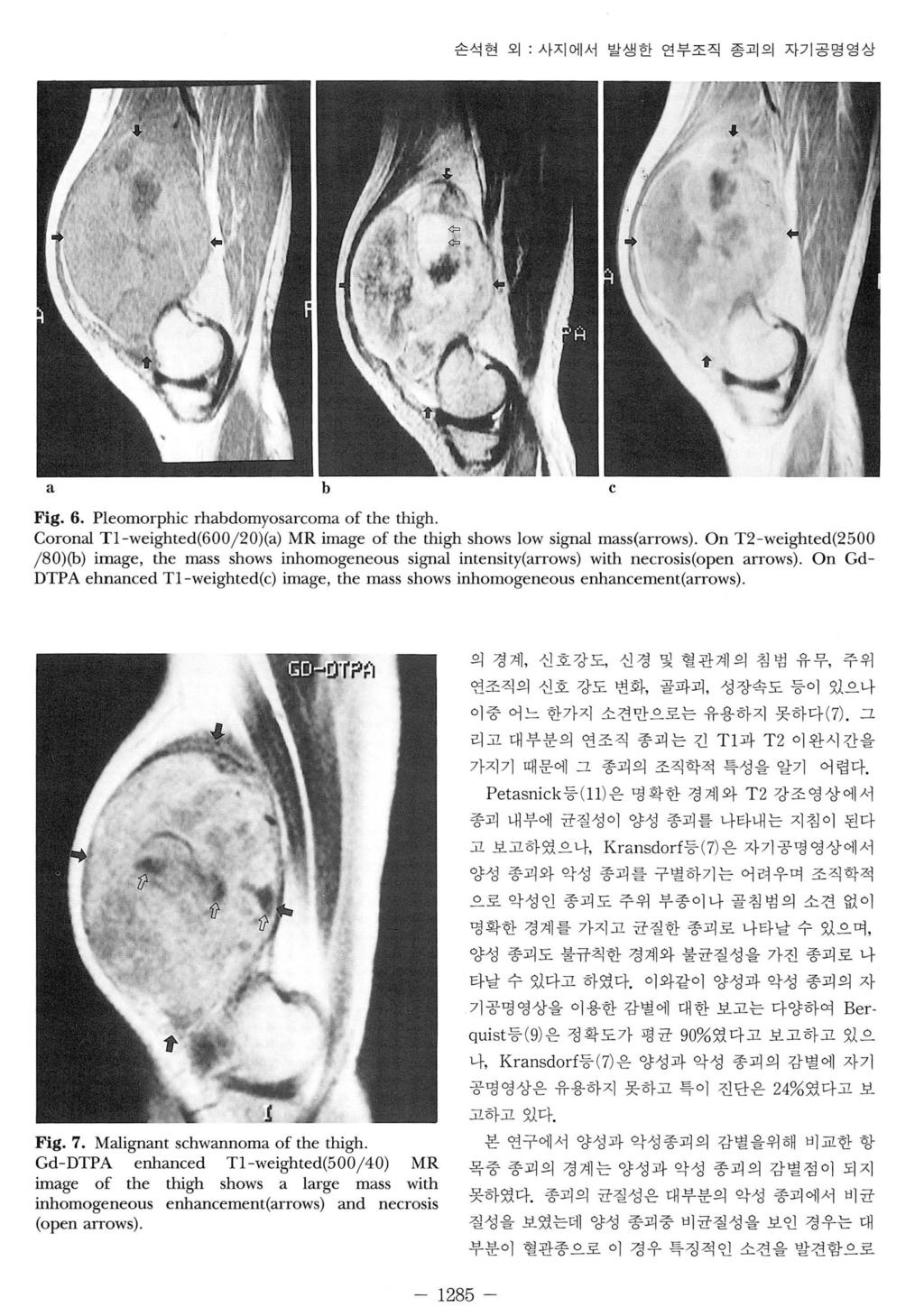 짧손석현오1: 사지에서발생한연부조직종괴의자기공명영상 a b c Fig. 6. Pleomorphic rhabdomyosarcoma of the thigh. Coronal Tl-weighted(600j 20)(a) MR image of the thigh shows low signal mass(arrows).