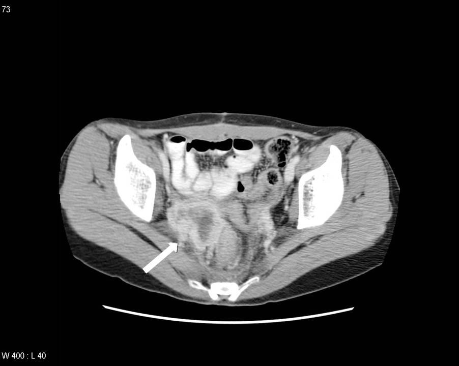 4 cm in diameter extended from vaginal stump to pelvic cavity (A) and hydronephrosis of right kidney due to pelvic mass (B).