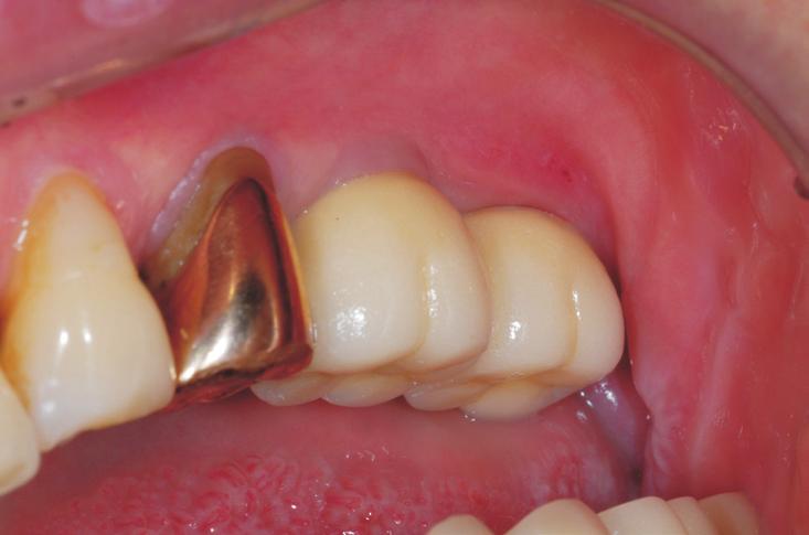 It was placed with non-submerged technique and connected with healing abutment.