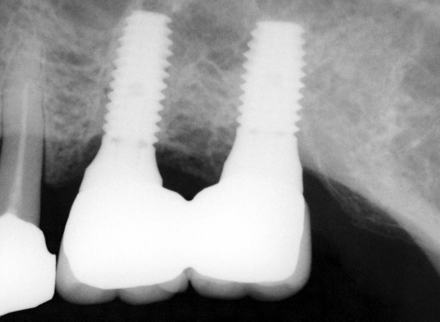 State of Hiossen implant placement Placement position Maxillary Incisors Molars Mandibular Incisors Molars