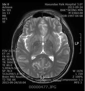 박정하 오득주 장수희 허희수 Fig. 1. Axial T TSE image: Meningo-encephalitis, mainly both medial frontal and insular. Fig.. Change on MMT. Fig.. Change on K-MBI. Fig.. Axial T TSE image: Multifocal signal change without significant enhancement in the both basal ganglia, thalamus.