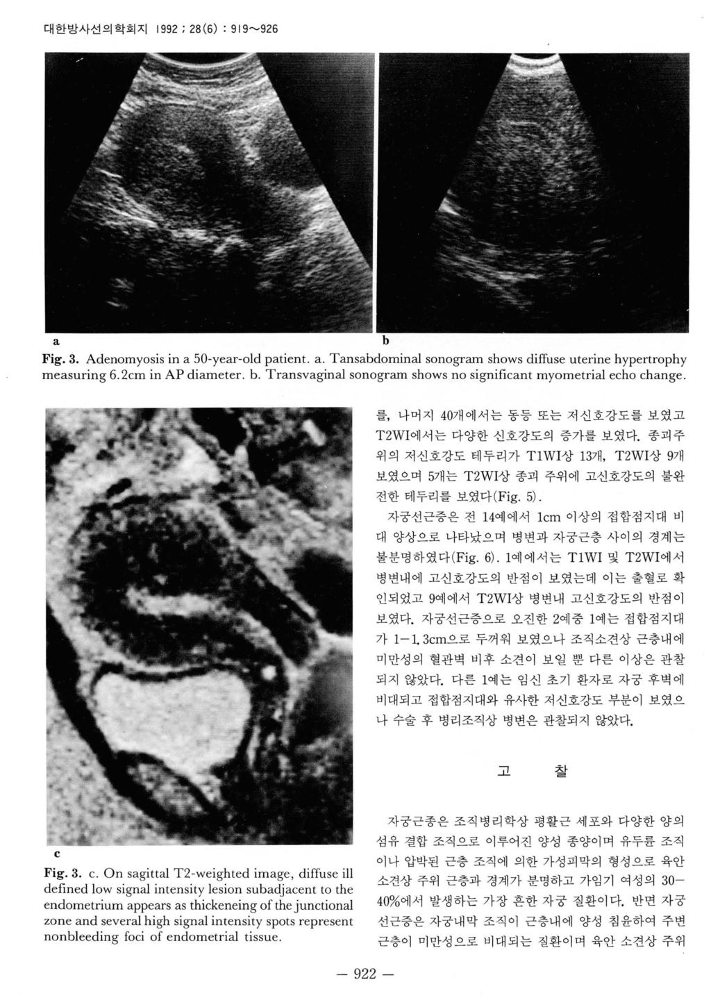 대한방사선의학회지 1992; 28(6) : 919~926 b Fig.3. Adenomyosis in 50-yer-old ptient.. T nsbdominl sonogrm shows diffuse uterine hypertrophy mesuring 6. 2cm in AP dimeter. b. Trnsvginl sonogrm shows no significnt myometril echo chnge.