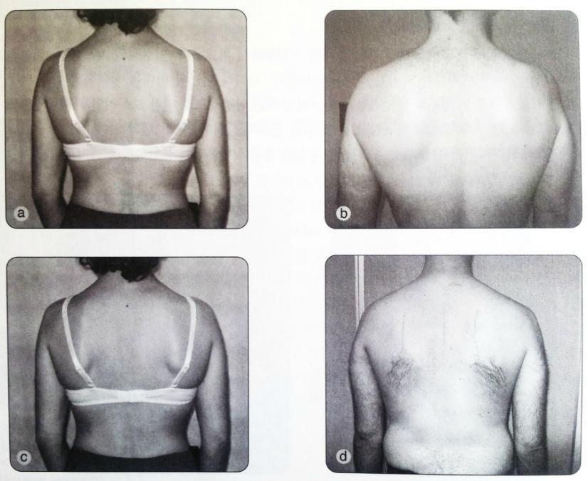 (a) 어깨뼈사이부위의돌출또는능형근과중승모근억제또는약화. (b) 어깨뼈극하근또는극상 (supraspinous fossa) 의돌출은회전근개의억제또는약함.