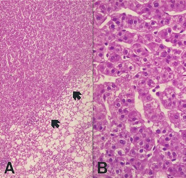 390 6 3 2000 Figure 4. Microscopic feature of well differentiated hepatocellular carcinoma (HCC) in dysplastic nodule. A. Low power view show ing subnodule of increased cell density (arrows). B.