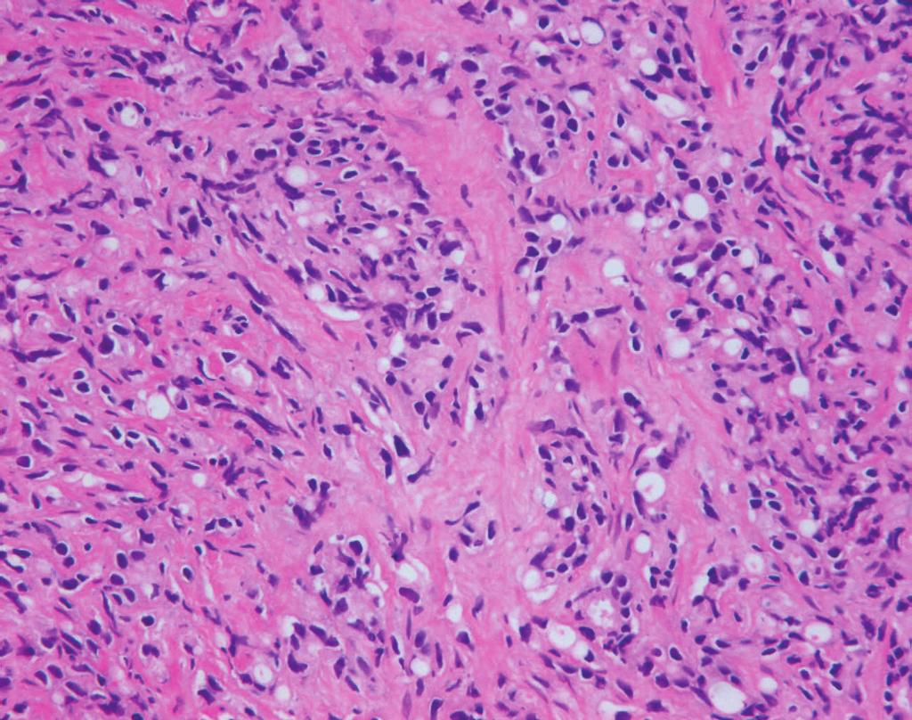 Many tumor cells showed moderate nuclear atypia or signet-ring cell-like features. There were also solid sheets that did not form discernible glands.