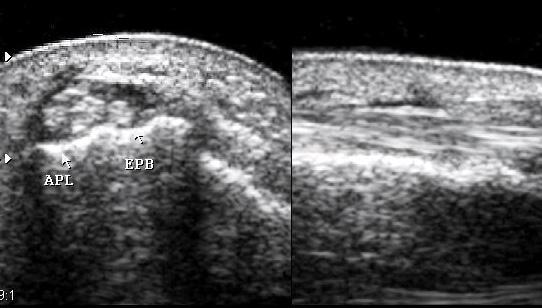 이두힘줄은배측수근인대 (dorsal carpal ligament) 에의해형성되는골섬유관 (osseofibrous canal) 내에윤활막이있는건초를공유하고있다.