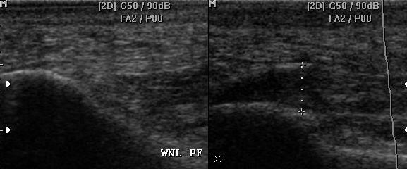 발바닥근막세로스캔 : 좌측은정상우측은병변. 뒤정강근힘줄기능장해 (Tibialis posterior tendon dysfunction) 뒤정강근힘줄기능장해 (TPTD) 는중년의여성에서가장흔하게발생한다. 병인은다양해서신발과생체역학적인자들이모두관련되어있다.