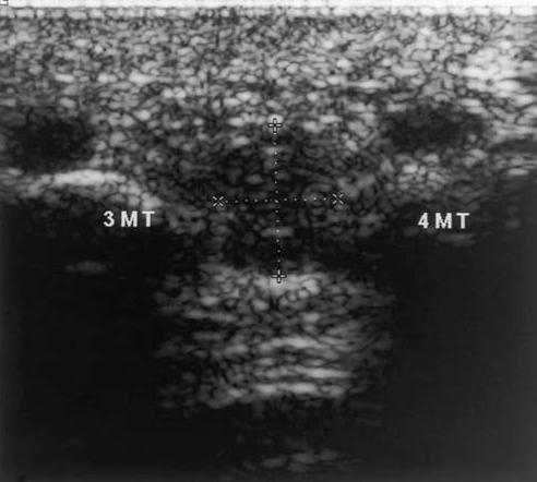 안재기 : 소관절부 ( 수부및족부 ) 의초음파진단 전족부의가로스캔 ( 좌 ) 과 MRI 소견 ( 우 ). 제 3-4 족지사이의저에코의둥근불균질의 mass 가관찰된다.