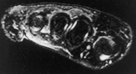 결절종 (Ganglion cyst) 윤활낭의일종으로관절또는힘줄막과연결된섬유성낭내에점액성물질을함유한낭성종양이다. 단순방사선촬영에서는크기가큰경우에만연부조직종괴로알수있지만대부분정상이다.