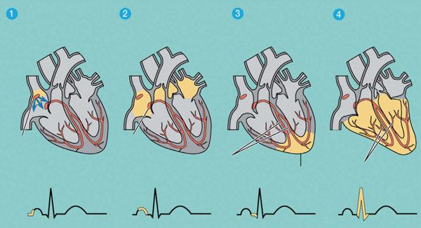 1) 심장 심장은매우독특한구조로구성되어있다. 하나의장기인심장은두개의펌프를작동시키는 2 in 1 시스템으로만들어져있다. 좌우에두개의심방과심실이각각들어있으며, 좌우의 1심방 1심실이중벽이라는격벽으로완전히분리되어있다. 우심실은폐로혈액을보내혈액이산소를많이가질수있도록한후좌심실로보내고좌심실은산소가많은동맥혈을높은압력으로혈관으로내뿜어온몸구석구석으로공급한다.