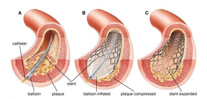 관상동맥성형술 (