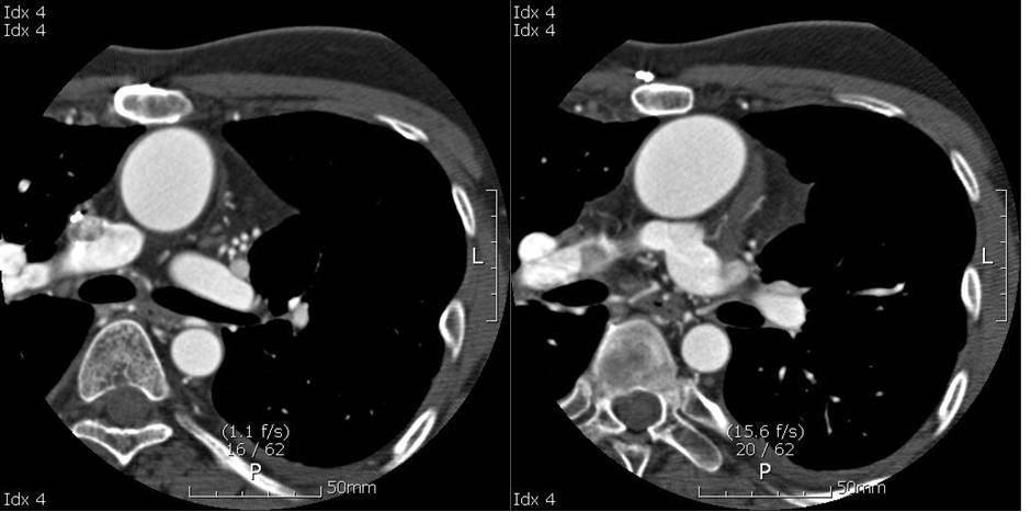 & T changes. Cardiac enzyme was within normal limits. Chest CT scan showed thrombosis at the BD Glenn shunt anastomosis site as well as part of proximal right pulmonary artery.