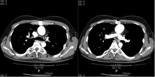 After thrombolysis, ABGA showed improved oxygen saturation above 90% on room air condition and symptoms disappeared.