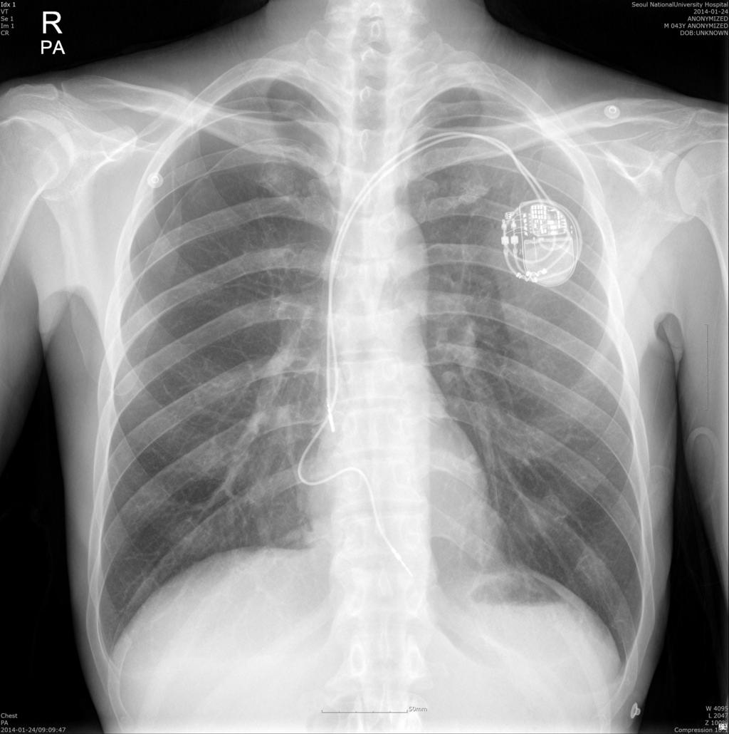 Poster to dyspnea had concomitant COPD and systolic heart failure.