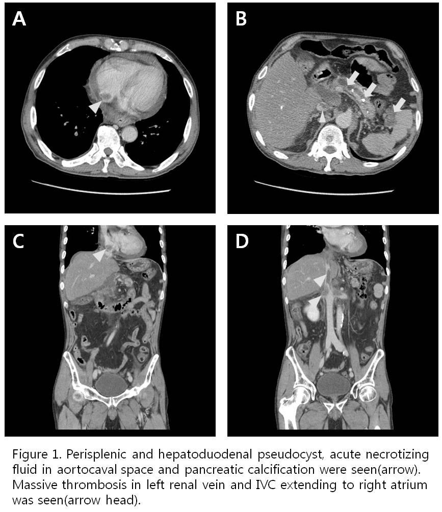 Poster and lipase (> 400 U/L) were elevated, consistent with acute pancreatitis. In imaging study, massive thrombosis with acute pancreatitis was seen (fig 1.). Gabexate and enoxaparin was administered for pancreatitis and thrombosis.