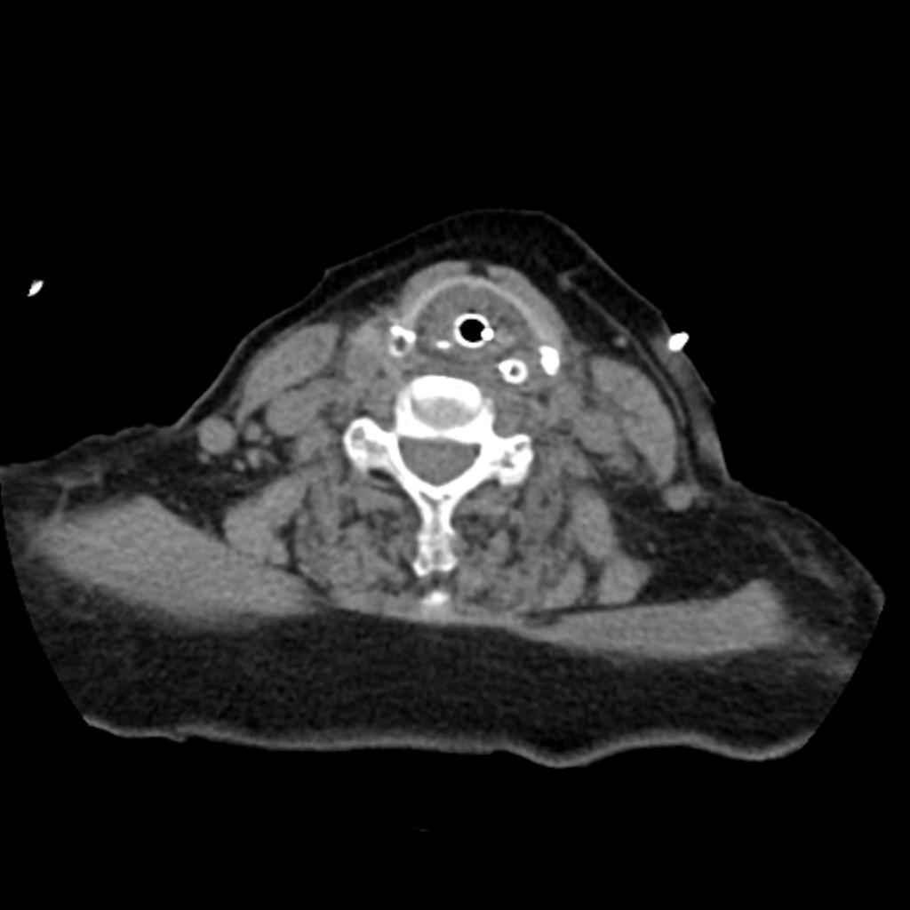 was changed to intravenous since the patient showed persistent diarrhea.