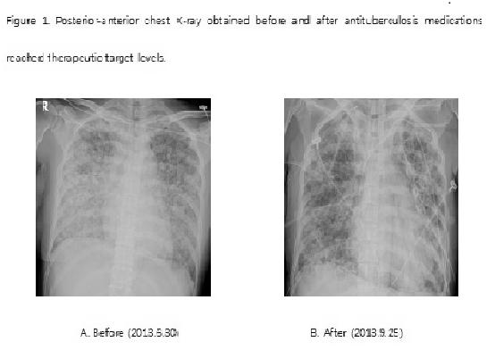 After then, her trans-tracheal specimens have no bacillus consistently. Patient was weaned from ECMO on 85th day of hospitalization, and we return the standard dose.