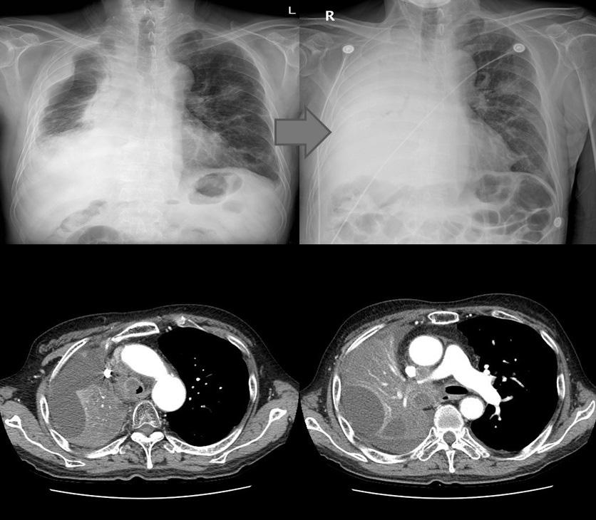 Poster Center for Lung Cancer, Research Institute and Hospital, National Cancer Center, Goyang, Korea Introduction: This is the first case of successful emergency cryoextraction of massive mucus