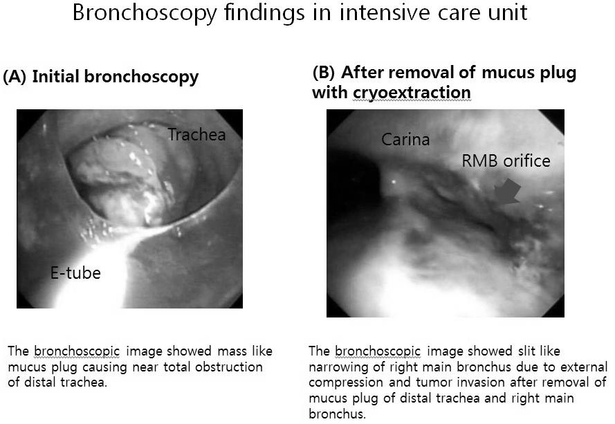 Case report: A 64 year-old man visited emergency room (ER) due to sudden dyspnea. He was diagnosed with adenocarcinoma of lung of clinical stage IV, two years ago.