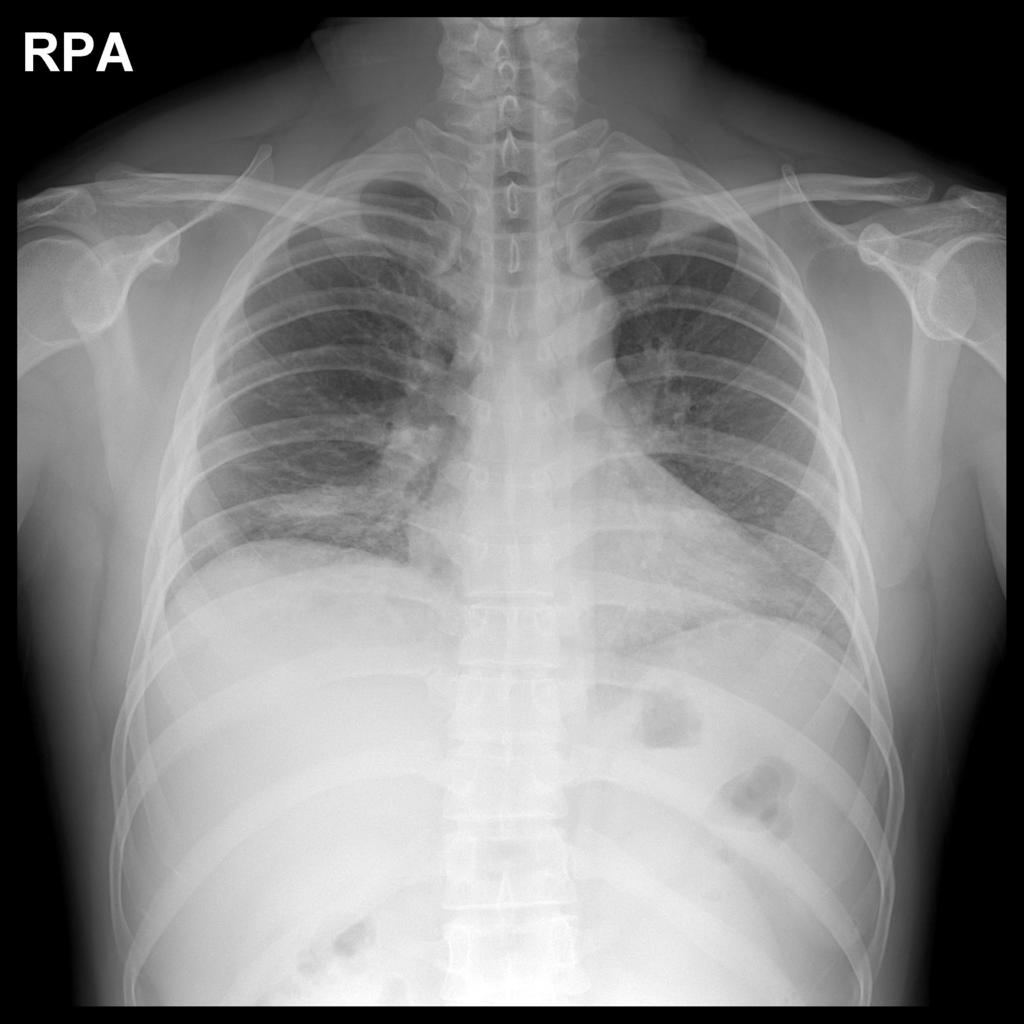 Oral Hepatopulmonary syndrome takes place in patients with liver cirrhosis in which nonfunctiong liver cannot metabolize the strong vasodilator, Vasoactive Intestinal Peptides that cause pulmonary