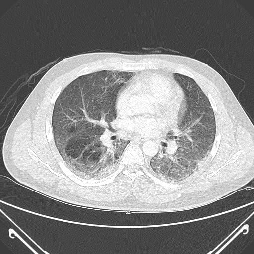 In this report, we present a patient with mild hepatitis, in whom the highest value of serum alanine aminotransferase enzyme (ALT) was only 390 units/l, who developed severe hypoxia.