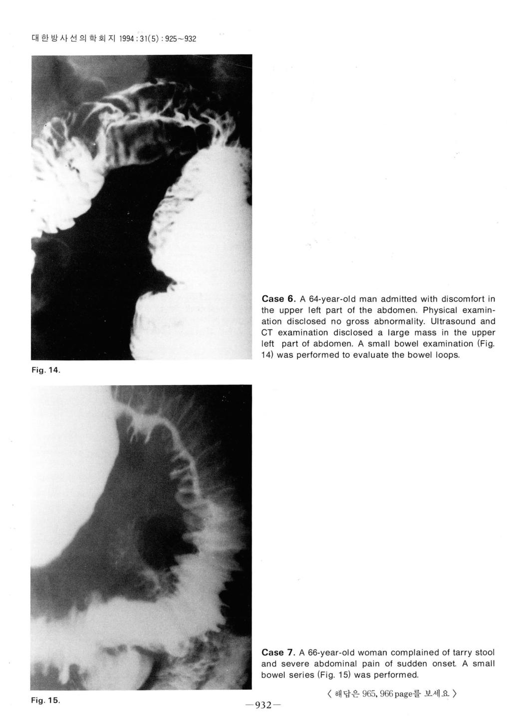 대한방사선의학회지 1994 ; 31 ( 5) : 925-932 Fig.14. Case 6. A 64-year-old man admitted with discomfort in the upper left part of the abdomen. Physical examination disclosed no gross abnormality.