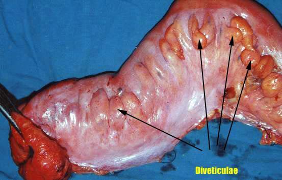 장게실증 (intestinal diverticulosis)