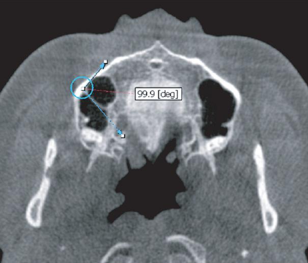 Fig. 3. The length and angle of septum with lateral wall of sinus on axial view. SeHeung Choi et al. : Morphological Aspect Analysis of Maxillary Sinus Septum Using ConeBeam Computed Tomography.