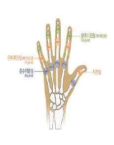7) 손가락에뚜렷한장해를남긴때 라함은첫째손가락의경우중수지관절또는지관절의굴신 ( 굽히고펴기 ) 운동영역이정상운동영역의 1/2 이하인경우를말하며, 다른네손가락에있어서는제 1, 제 2 지관절의굴신운동영역을합산하여정상운동영역의 1/2 이하이거나중수지관절의굴신 ( 굽히고펴기 ) 운동영역이정상운동영역의 1/2 이하인경우를말한다.