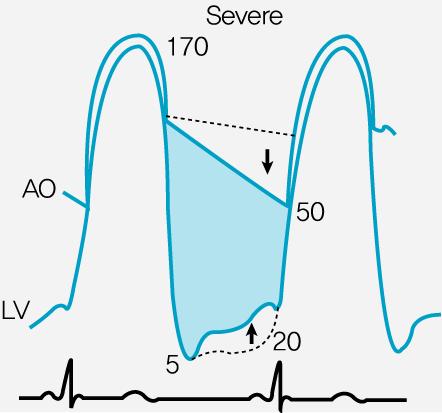 area<1cm +증상 or EF<50% 수술기다리기힘든경우 : percutaneous balloon aortic valvuloplasty ( 계속) AS 수축기시 AV를통해혈액이잘빠져나가지못해