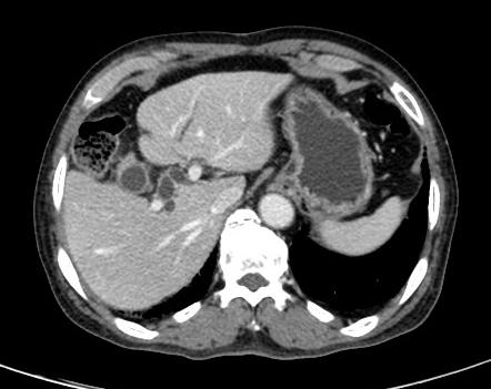 A Case of Diffuse Large B-cell Lymphoma of the Gallbladder B.