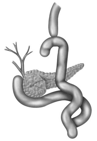 김진홍ㆍ황재철 :ERCP in Anatomical Alteration 339 4. 전위절제술 위암을치료하는데사용되는전위절제술후에는단- 측식도-공장문합술이형성된다. 식도-공장문합술의하나의내강은막힌끝이되고나머지는원심성고리가된다 (Fig. 4). 이원심성고리에서조금아래로떨어진곳에췌장과담도의내용물을받아들이기위한측-측또는단- 측공장문합부위가있다.