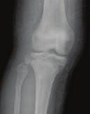 팔 다리 손가락 발가락 손목 팔꿈치 어깨 발목 무릎 대퇴골 척추등신체뼈중관절과직접연결되어있는긴뼈의끝부분에있으며,