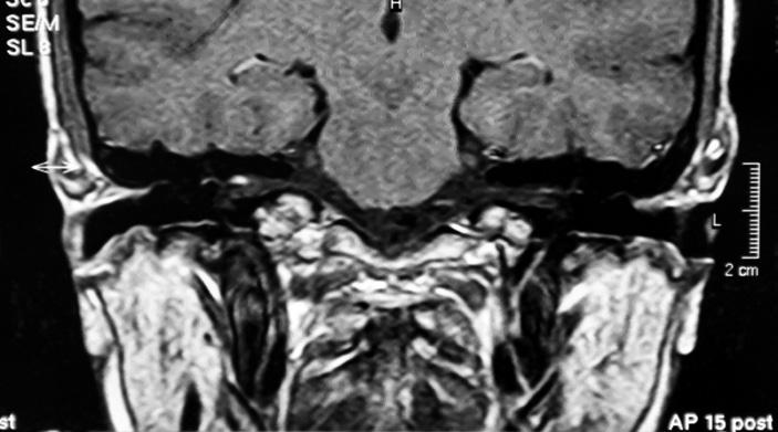 labyrinthine segment of Rt facial nerve enhanced abnormally, and its ganglion and proximal tympanic