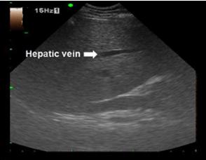 Postgraduate Course 2012 A B C D Figure 3. Hepatic vein (HV) enhancement with microbubble contrast-enhanced ultrasonography and the measurement of the HV arrival time (HVAT).