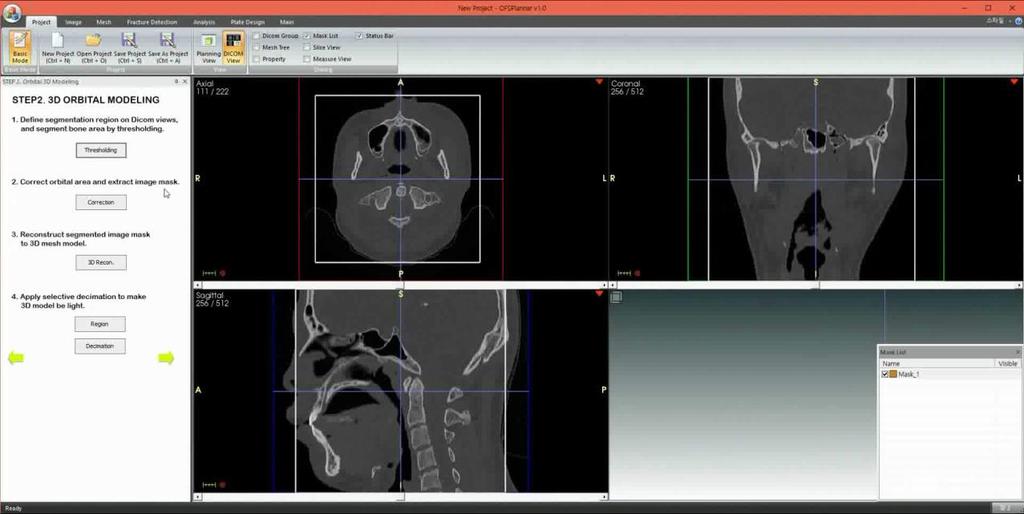 3D Patient Modeling Automatic Orbital Wall Modeling Existing method: manual