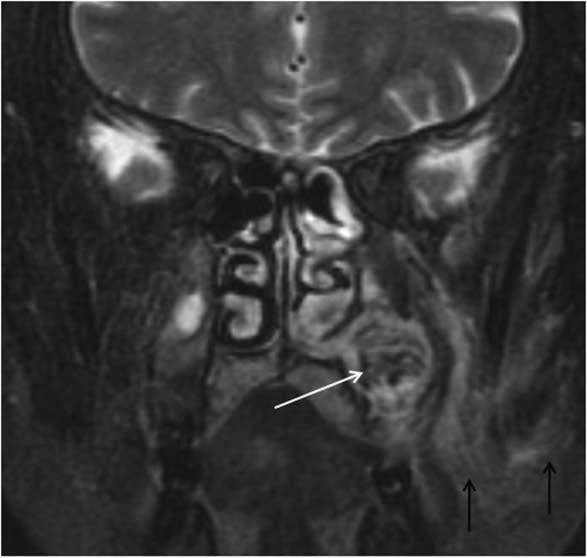 Coronal CT scan with bone algorithm shows irregular destruction of the alveolar bone of the left posterior maxilla.
