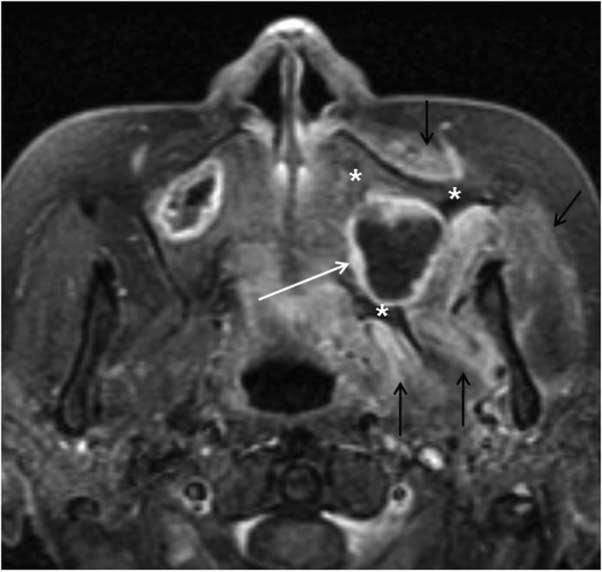 Ipsilateral maxillary and ethmoid sinuses as well as the nasal cavity are opacified by the inflammatory tissues. Note the sclerotic change of the adjacent bones (black arrows). B-D.
