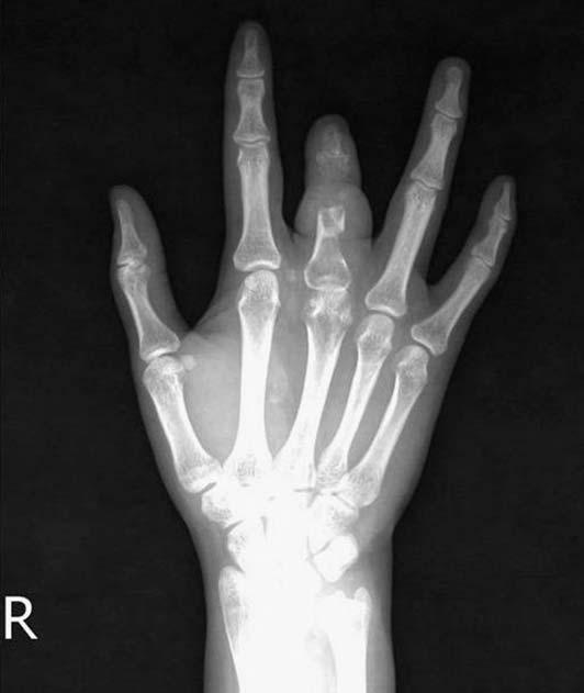 (B) Postoperative X-ray shows massive removal of infective bone. Fig. 4.