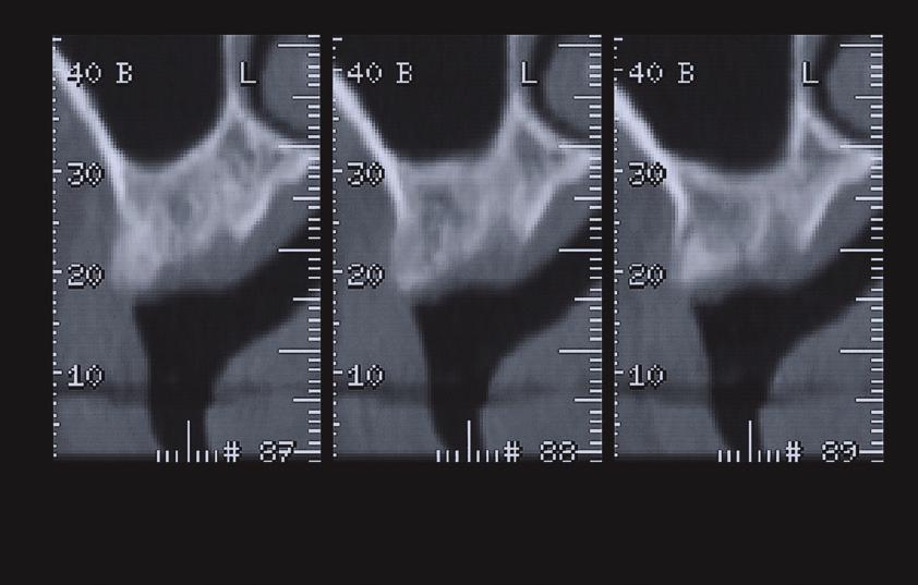 결과적으로, 협진 진료팀의 구성원이 마운팅 모델을 활용하여 필요한 임플란트 위치와 각도(Lazzara, Porter 2001)를 조정할 수 있으려면 각 환자마다 방사선 사진을 세부적으로 분석해야 한다(그림 1.4 및 1.5). 수술 전 치료 계획 시 뼈 융선의 상태, 이전 흡수의 패턴 및 해당 뼈의 각형성 (특히 상악 전치부)을 고려해야 한다.